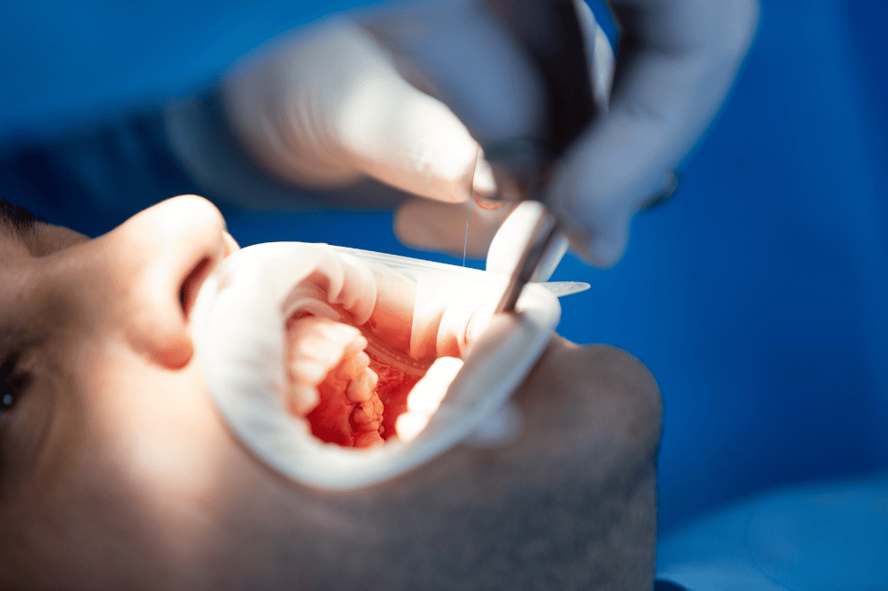 crown lengthening procedure, recovery, and considerations