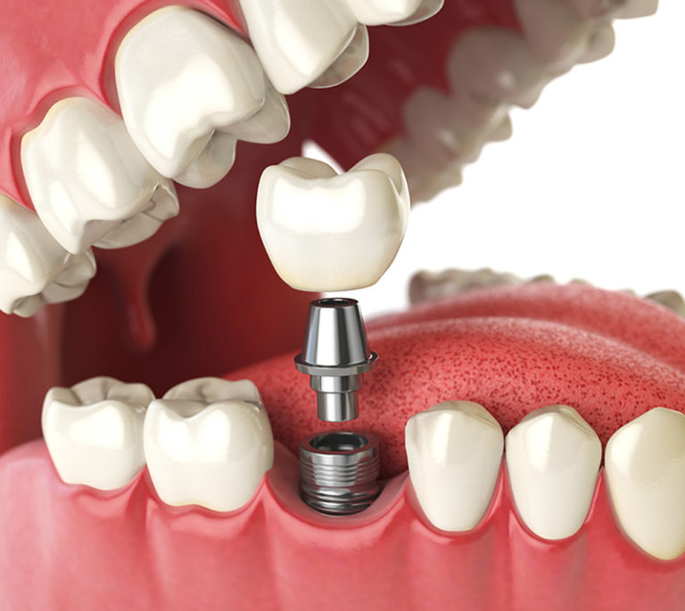 Dental Implants in Blackfalds