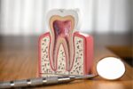 root canal benefits
