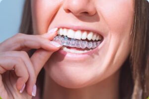 invisalign near Red Deer