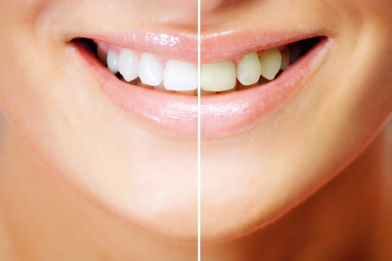 What Causes Green Tooth and Other Tooth Discoloration?