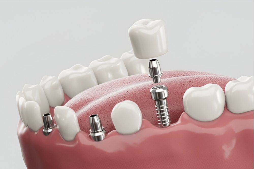 dental implants clinic Blackfalds