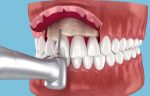 what is crown lengthening and why would a dentist recommend it